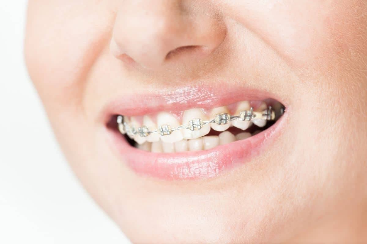 close up of a woman's mouth with braces