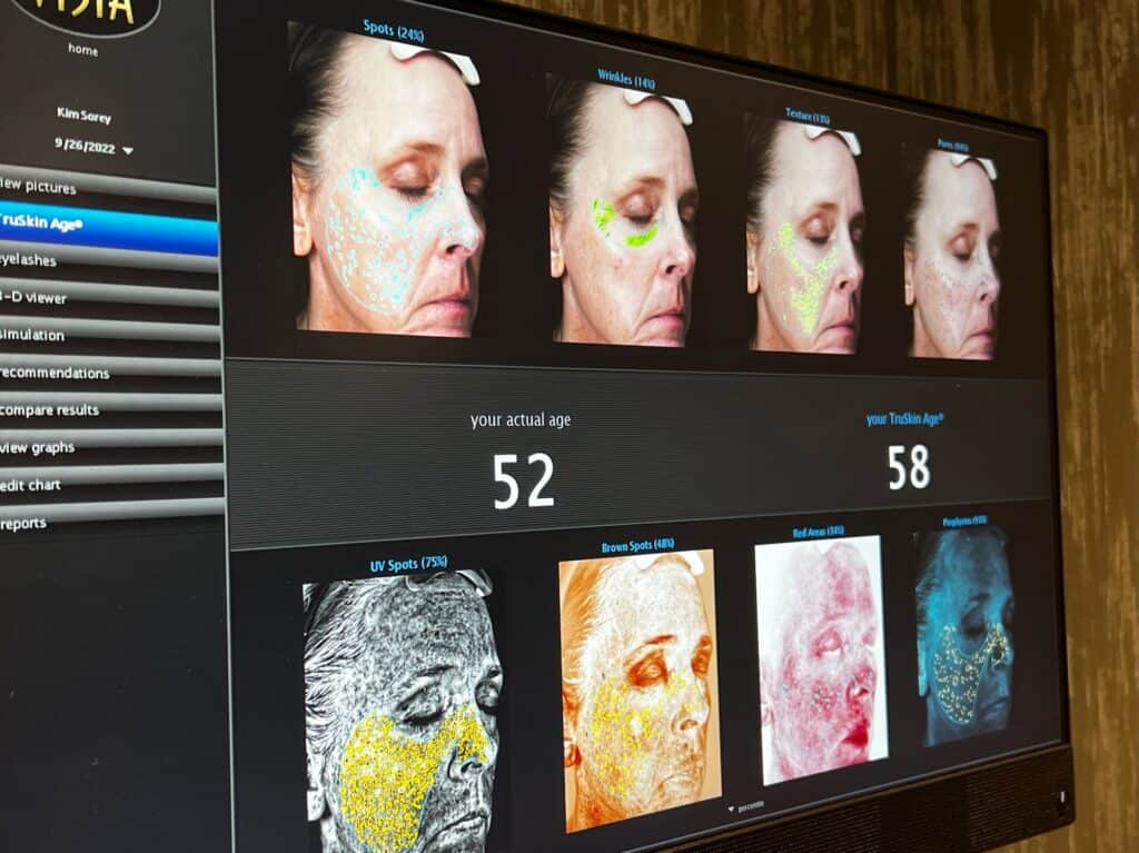 Visia skin analysis results