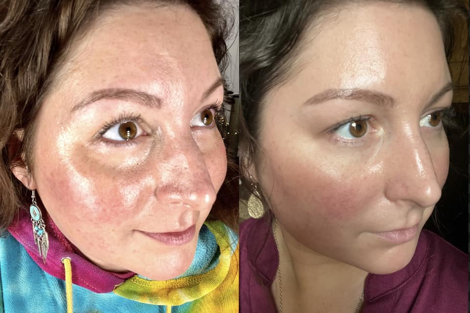 Before and After - Serum 1, The Cure, and the Cream 6 day before and after