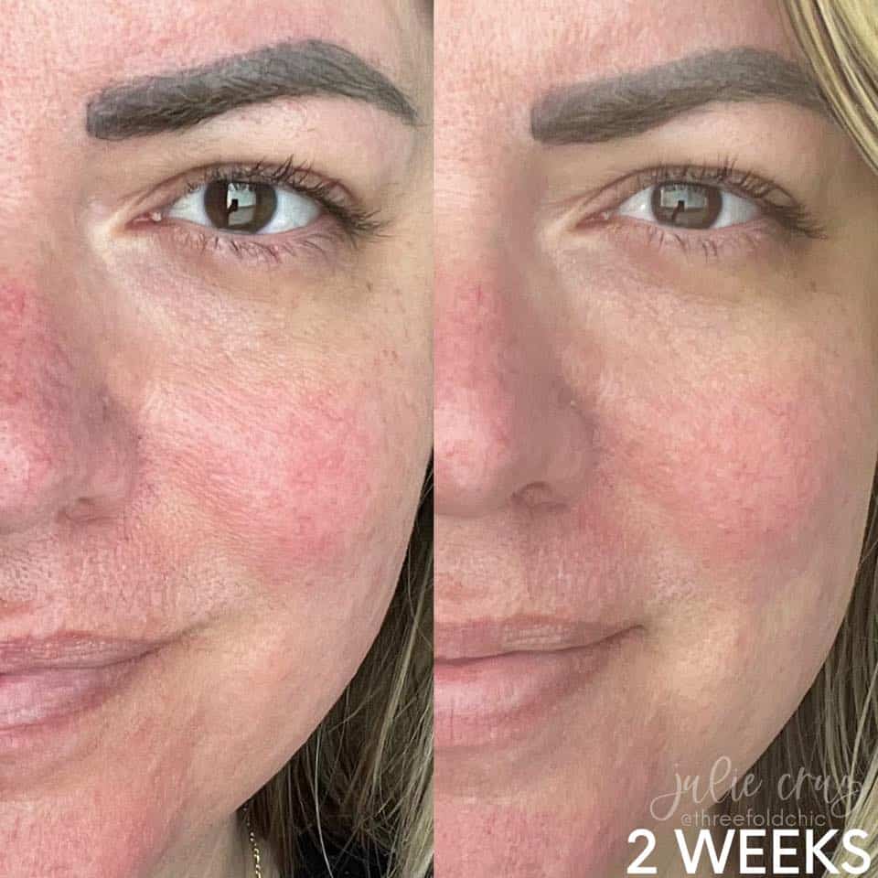 She used The Cure Soap, Serum 1, The Cure, and The Cream for 2 weeks.