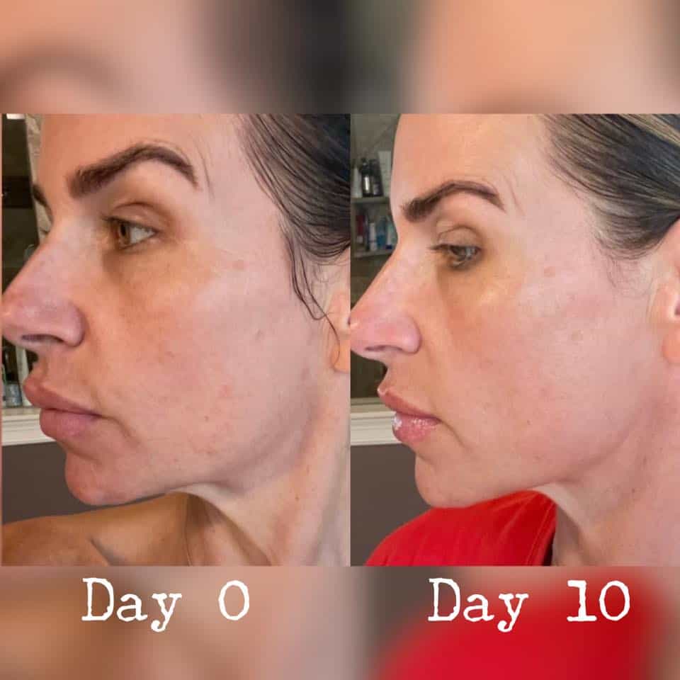 She used Herbal Face Food's The Cure, The Serum and The Cream - before and after 10 days