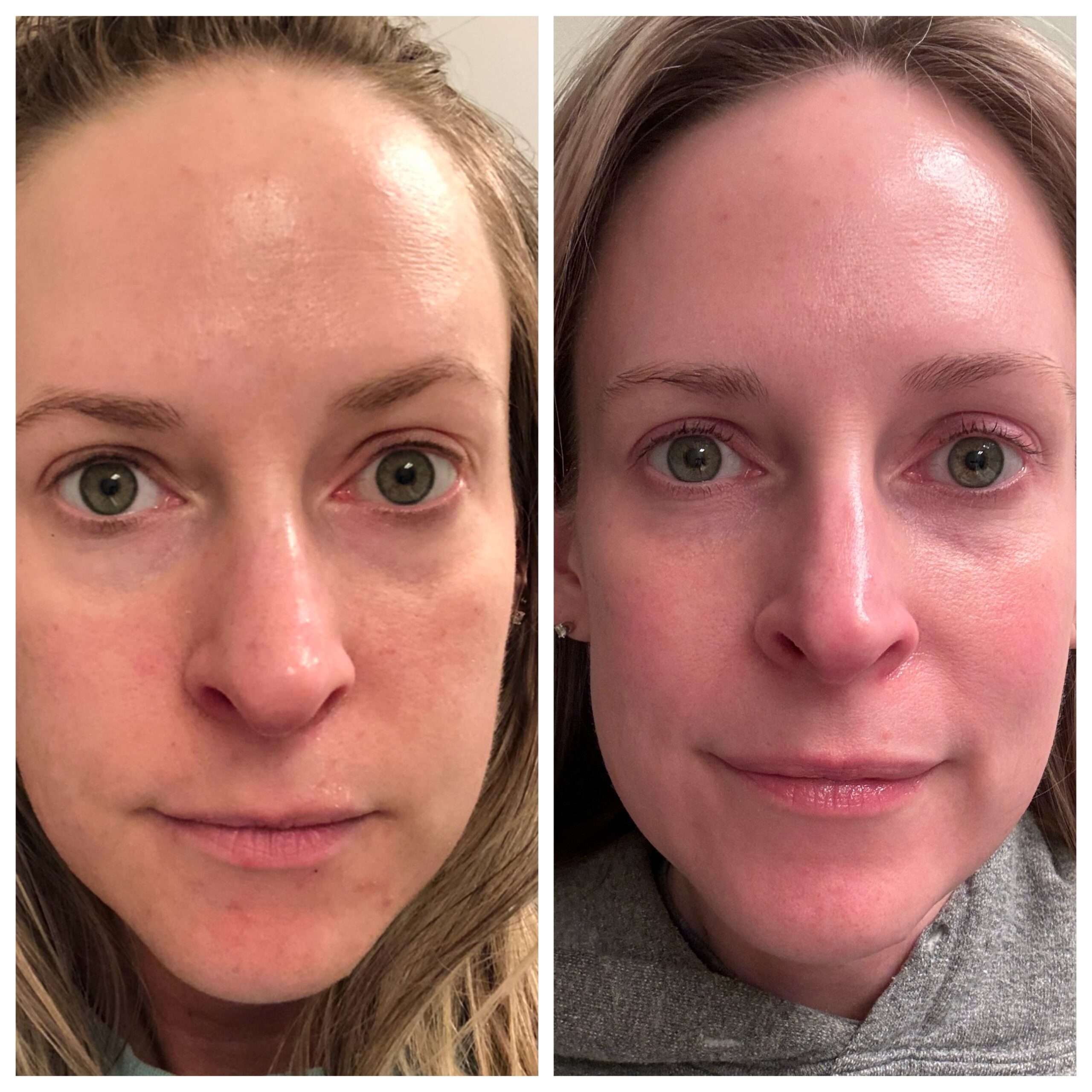 my currentbody red light mask before and after